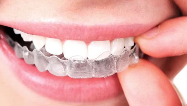 ¿Cómo funciona la ortodoncia Invisalign?