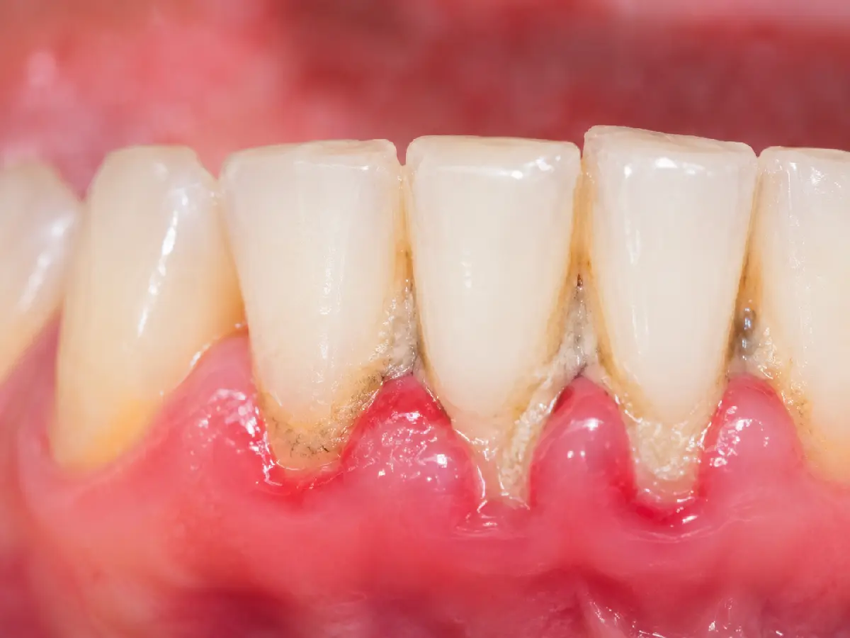 Diente y encía afectados por enfermedad periodontal o piorrea
