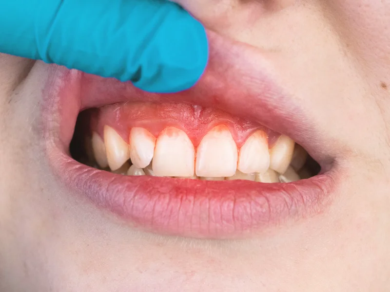¿Cómo prevenir la gingivitis?
