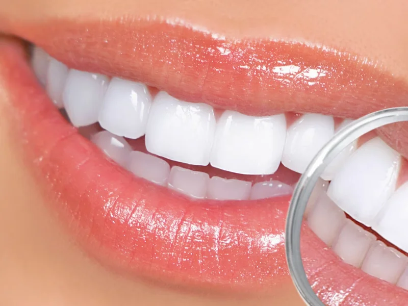 Blanqueamiento dental