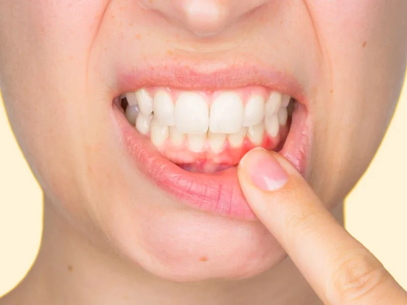 Prevención de problemas de encías