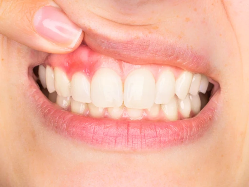 ¿Qué son la periodontitis y gingivitis?