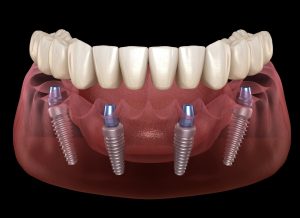 ¿Cuántos tipos de implantes dentales hay?