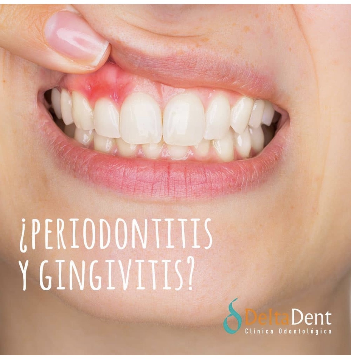 periodontitis.jpg