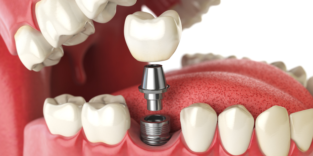 Implantes Dentales De Titanio